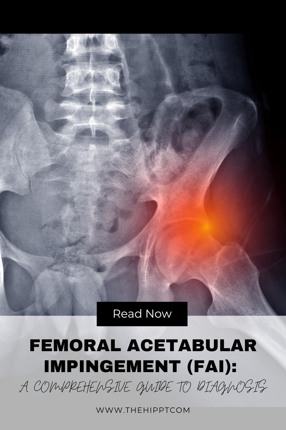 Femoral Acetabular Impingement Fai A Comprehensive Guide To